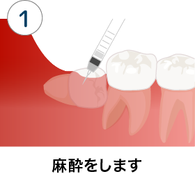 親知らず 抜歯 痛み