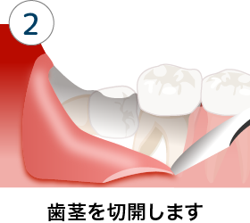 親知らずの抜歯