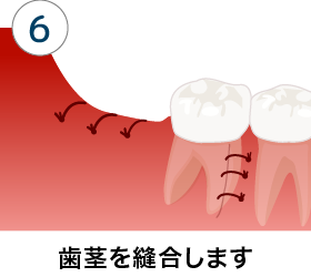 歯茎 腫れ 後 抜歯