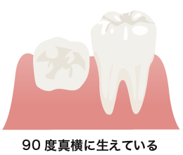 横向き 親知らず 親知らずは抜いた方がいいですか？抜歯の費用はいくらかかりますか？