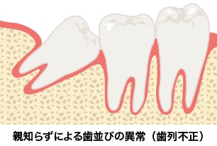 親知らず 糸 抜き